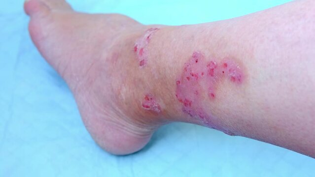 close-up of human shin, numerous wounds on leg of adult female patient, redness, scarring, sores from scratching, burn, concept of medical care, self-harm to skin, human tissue regeneration