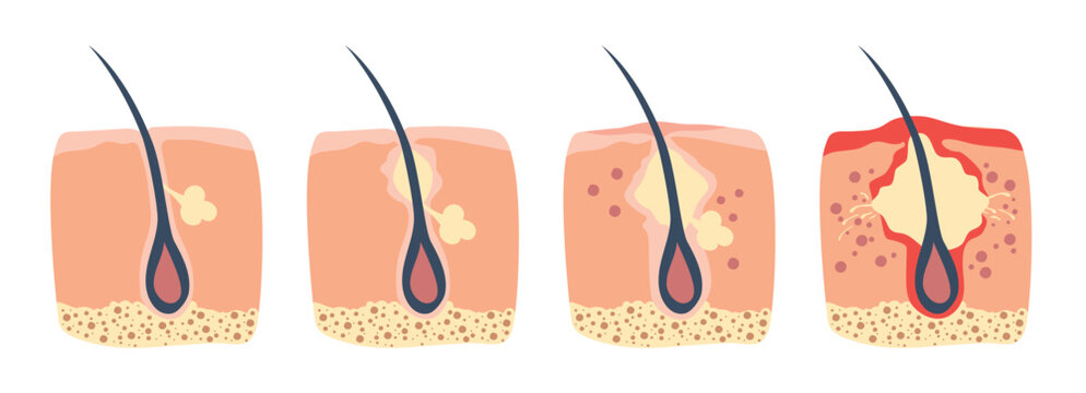 Stages of hair follicle inflammation in human body