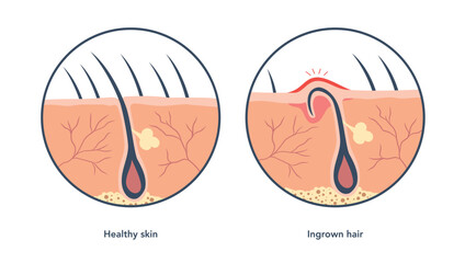 Ingrown hair medical scheme under microscope