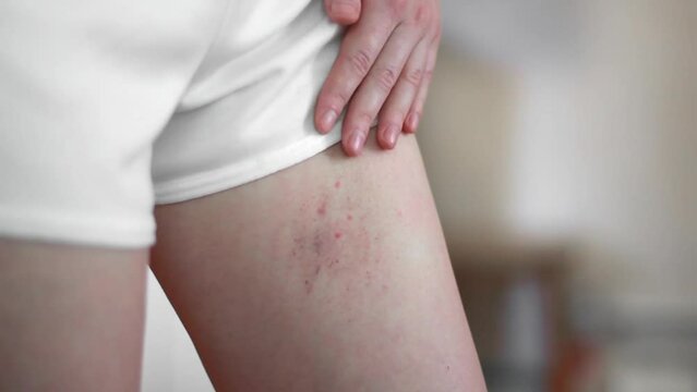 A woman was bitten by an insect on the leg close-up. Consequences of insect bites. Allergic reaction from the bite.