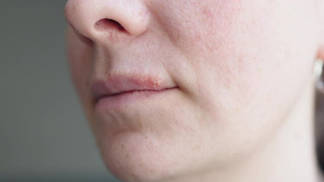 virus herpes simplex on lip skin, sore vesicles cause discomfort of herpes bumps on woman face. smiling woman face with herpes on lip. itching burning feeling symptoms upper lip viral disease herpes