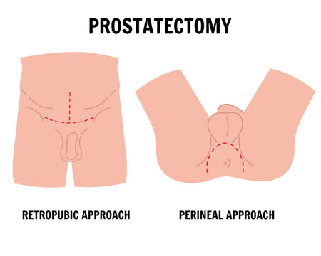 Medical infographic male prostatectomy in vector