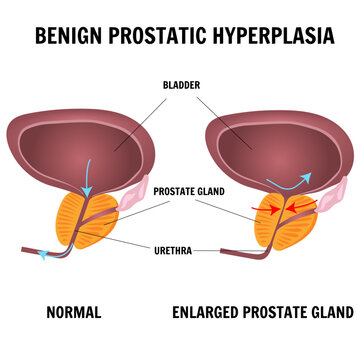 Medical infographic normal prostate and benign prostatic hyperplasia in vector