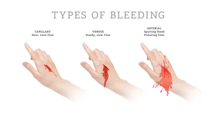 Deurstickers Three main types of bleeding © Aldona