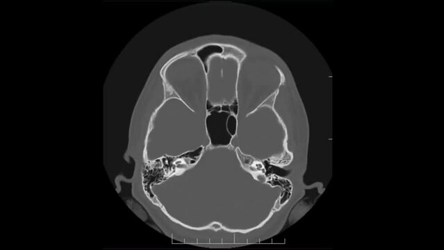 Human Skull 3d Scanning, CT and MRI Scanning