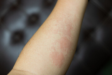 Allergic rash dermatitis eczema skin of patient. hand in scratching itchy, itch red spot or rash of...