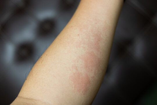 Allergic rash dermatitis eczema skin of patient. hand in scratching itchy, itch red spot or rash of skin. Healthcare.