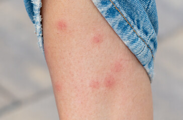 Mosquito bites on the skin of the leg. Close-up