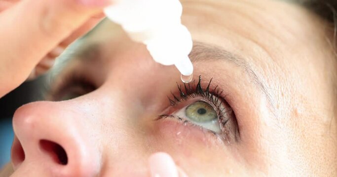 Closeup of woman pouring drops into red eye with conjunctivitis or glaucoma. Poor vision and pain
