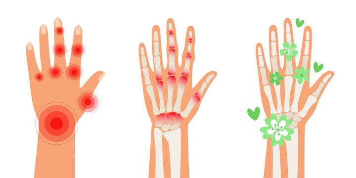 Rheumatoid Arthritis hands. Pain in the human body. Arthritis, bone disease medical poster. Finger arthritis vector illustration. Chronic skeleton pain