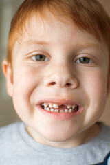 Portrait of a red-haired six-year-old boy without a front tooth. A child's smile without an upper tooth