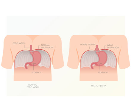 Hiatal Hernia - Hiatus Opening in Diaphragm - Stock Illustration
