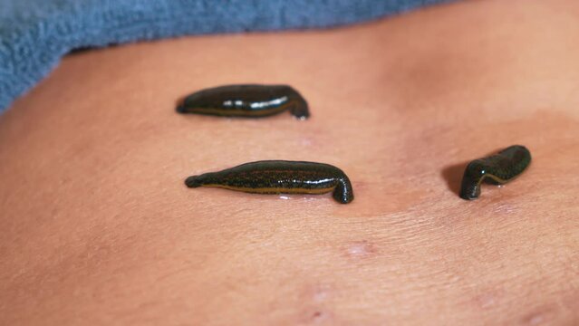 Treatment with leeches. A doctor performs a hirudotherapy procedure for a man. A doctor plants leeches on a man's back. The help of leeches for the treatment of the body. Alternative medicine. A close