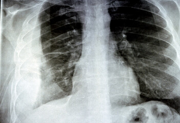 Plain X ray for a patient with aspiration pneumonia right lung, empyema, pleural effusion after...