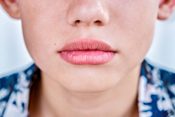 Chapped lips of preteen schoolboy from dry weather on sea resort. Schoolboy with chapped rose lips sitting on hot sea beach closeup - 632448046