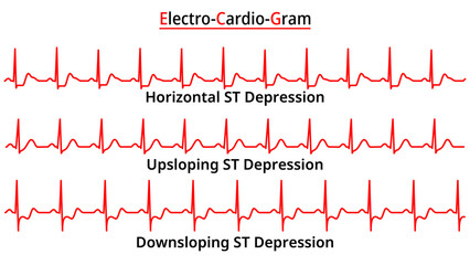 Set of ECG Common Abnormalities - ST Segment Depression - Upsloping - Downsloping - Horizontal - Electrocardiogram Vector Medical Illustration - obrazy, fototapety, plakaty