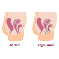 Vaginismus. Spasm of the muscles of the vagina and pelvic floor. Medical infographic, poster, tutorial. Vector illustration