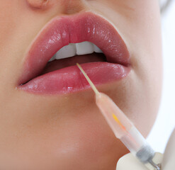 A woman with full lips receiving a lip filler injection procedure