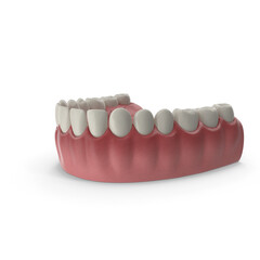 Lower Teeth Medical Model With Dental Implant,  jaw with abnormal teeth position. Orthodontic treatment concept.