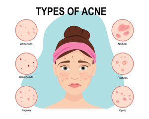 Types of acne. Skin problems