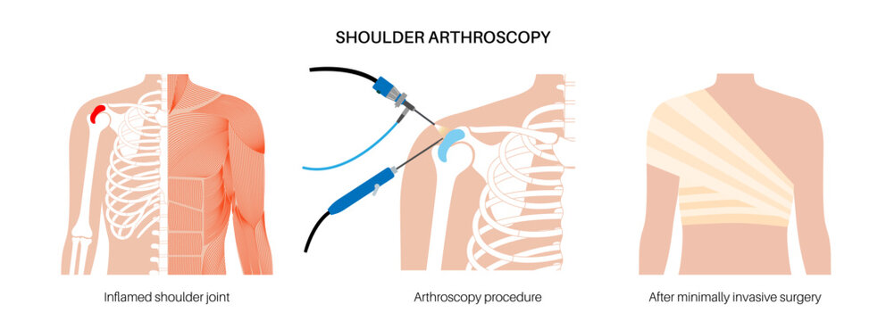 Shoulder arthroscopy poster
