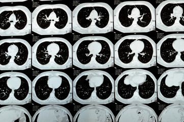 Multi slice CT scan of the chest showing normal study, normal appearance of the lungs, parenchyma, pulmonary vasculature,  mediastinal structures, no adenopathy, no pleural effusion, no abnormality