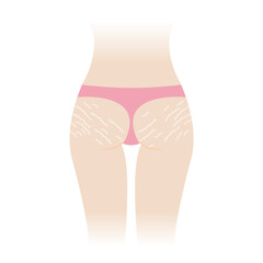 Stretch marks on buttocks vector illustration isolated on white background. The white stretch marks appear on the bottom, hip, ass of woman body. Skin care and beauty concept.
