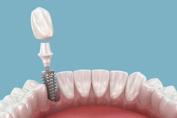 Dental implant and ceramic crown. Medically accurate tooth 3D illustration.