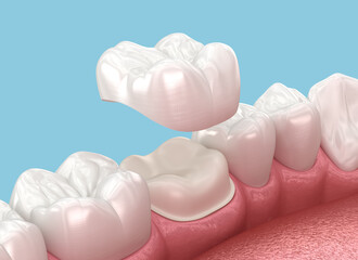 Dental crown placement over molar tooth. 3D illustration