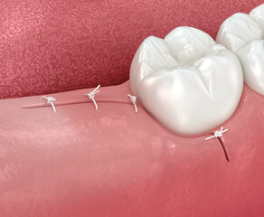 Stitches on gum after wisdom tooth extraction. 3D illustration of dental treatment