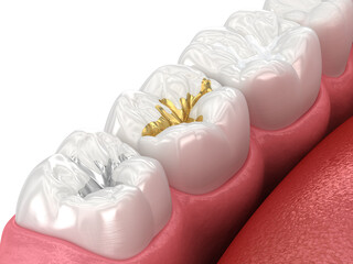 Dental fillings: ceramic, golden, metal. Dental 3D illustration