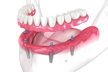Dental prosthesis based on 4 implants. Dental 3D illustration - obrazy, fototapety, plakaty
