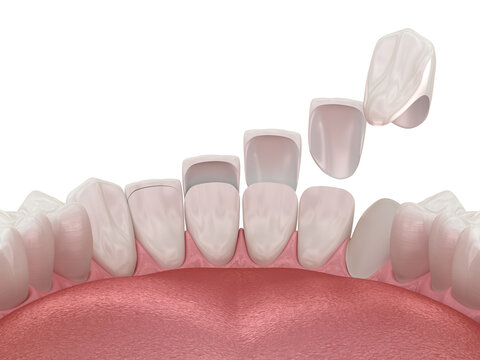 Dental veneer placement over frontal teeth. 3D illustration