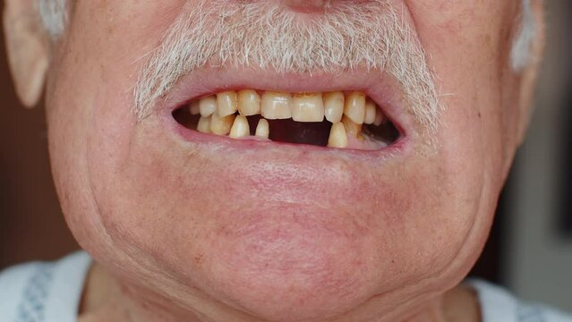 Close-up macro shot of toothless male smile mouth of senior elderly man. Dental problem, bad teeth loss. Pensioner grandfather showing rotten teeth, caries, decayed and weak enamel, teeth falling out