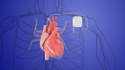 pacemaker in a human heart implant vein in the heart	