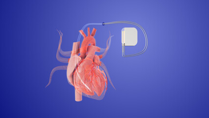 Artificial cardiac pacemaker anatomical scheme	
 - obrazy, fototapety, plakaty