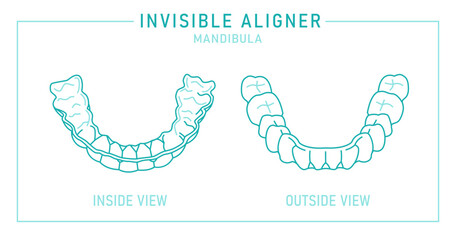 Orthodontic silicone trainer. Invisible braces aligner, retainer. - obrazy, fototapety, plakaty
