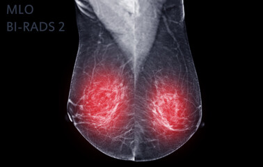  X-ray Digital Mammogram of Right  side  MLO view .