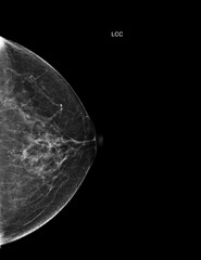  X-ray Digital Mammogram Left side  CC view . mammography or breast scan for Breast cancer  showing BI-RADS CATEGORY 2  Benign tumor.