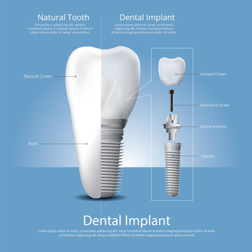 Human Teeth Dental Implant