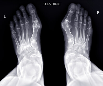 Foot x-ray image  AP  standing view  isolated on black background.