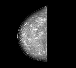 Mammography image showing  suggest malignancy.