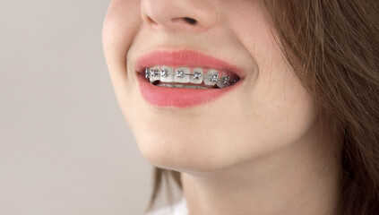 Portrait of a young girl with braces. Orthodontics, dentistry.