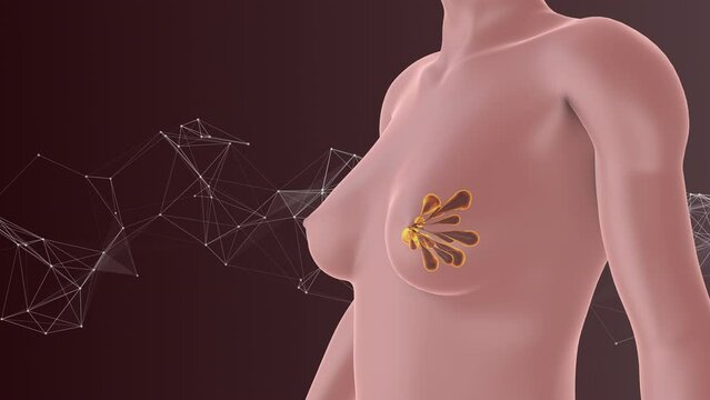  Conceptual visualization of breast cancer cells with plexus
