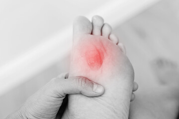 Close up black white photo of woman's foot sole with painful callus with red point. Female is suffering from pain due to corn on leg. The problem is due to tight shoes. Healthcare and medicine concept