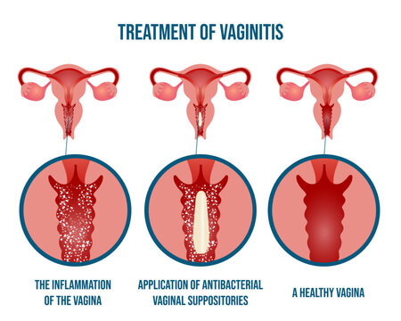 Gynecology disease, bacterial vaginosis, medical infographic, treatments of vaginitis
