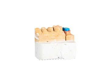 Dental prosthesis from gypsum model.
Plaster model of a part of a human jaw.
Plaster model of teeth. 
