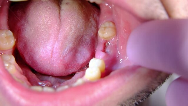 Close up of male jaw and healing wound after tooth extraction procedure.