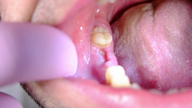 Extreme close up of almost healed wound or hole after tooth extraction.