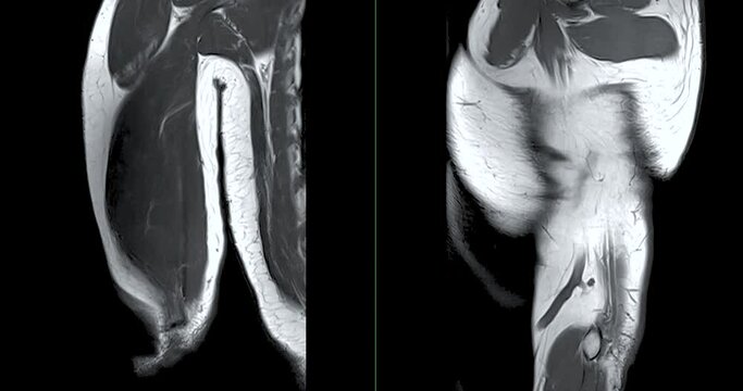 MRI Left humerus bone  for diagnosis bone tumor.